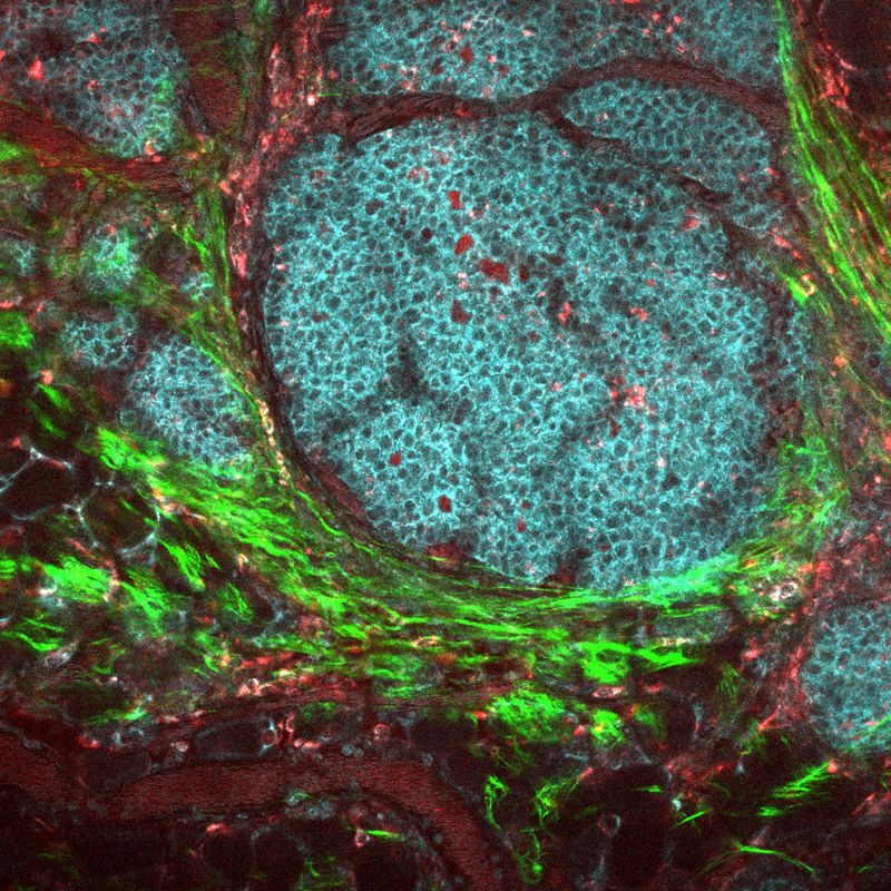 This image of a breast cancer tumor and its microenvironment was obtained from a live mouse model using multiphoton microscopy and endogenous fluorescence. That is, the image was obtained without any fluorophores, stains, or dyes, using only the metabolic co-factors of NADH and FAD, which are already inside of cells, along with second harmonic generation to see collagen. This technique has important clinical potential for patients who require label-free imaging, and may lead to more effective diagnoses and treatments. Tumor cells display in cyan, macrophages in red, collagen fibers in green.