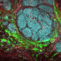 This image of a breast cancer tumor and its microenvironment was obtained from a live mouse model using multiphoton microscopy and endogenous fluorescence. That is, the image was obtained without any fluorophores, stains, or dyes, using only the metabolic co-factors of NADH and FAD, which are already inside of cells, along with second harmonic generation to see collagen. This technique has important clinical potential for patients who require label-free imaging, and may lead to more effective diagnoses and treatments. Tumor cells display in cyan, macrophages in red, collagen fibers in green.