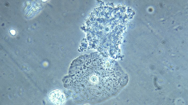 This photomicrograph of a vaginal smear specimen depicts two epithelial cells, a normal cell, and an epithelial cell with its exterior covered by bacteria giving the cell a roughened, stippled appearance known as a clue cell. The presence of clue cells is a sign that the patient has bacterial vaginosis.
