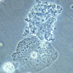 This photomicrograph of a vaginal smear specimen depicts two epithelial cells, a normal cell, and an epithelial cell with its exterior covered by bacteria giving the cell a roughened, stippled appearance known as a clue cell. The presence of clue cells is a sign that the patient has bacterial vaginosis.