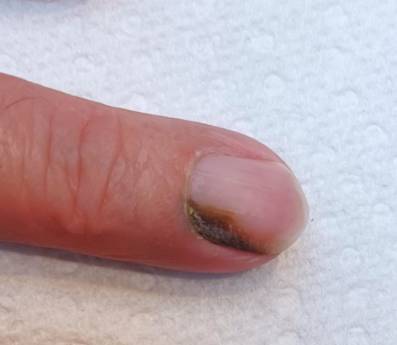 nail with chloronychia, a patch of greeny-black discolouration