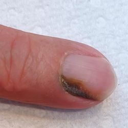 nail with chloronychia, a patch of greeny-black discolouration