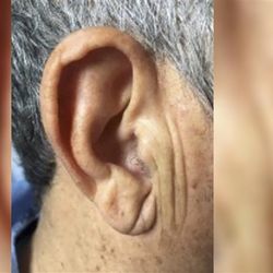 A photo showing an older person's ear demonstrating the deep crease of their lower right hand earlobe.