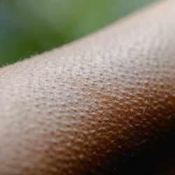 close-up photograph of goosebumps on an arm