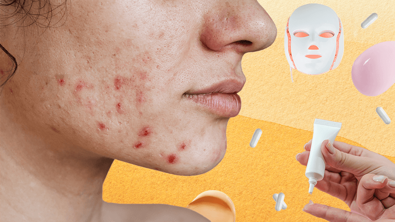 collage representing acne treatments: close up of a young woman with acne on her cheeks and chin; an LED therapy mask; splodges of face cream; white pill capsules; hands squeezing gel out of a tube onto a finger