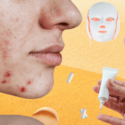 collage representing acne treatments: close up of a young woman with acne on her cheeks and chin; an LED therapy mask; splodges of face cream; white pill capsules; hands squeezing gel out of a tube onto a finger