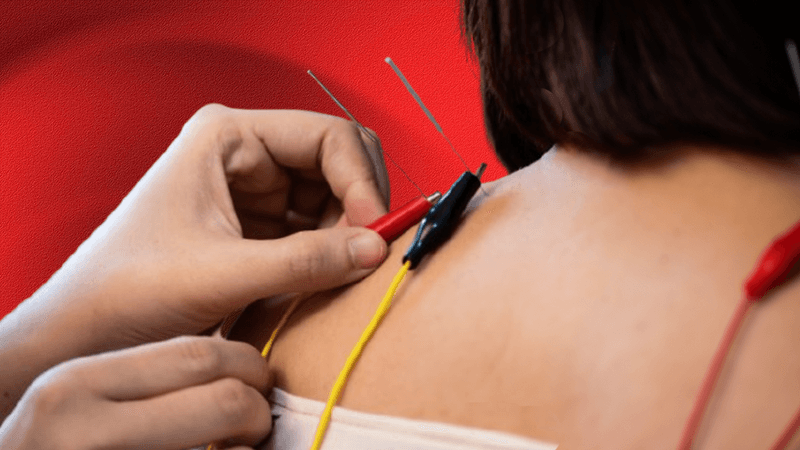 close up of a person placing electrodes onto acupuncture needles in someone's back