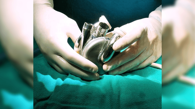 close up photograph of a surgeon's gloved hands holding a BiVACOR® Total Artificial Heart, which is made out of titanium