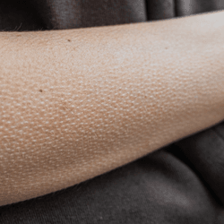 a human arm with little bumps from cold they are goosebumps a vestigial reflex